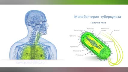 Туберкулёз. С болезнью можно бороться,  выявляя на ранней стадии