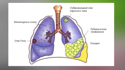Всемирный день борьбы с туберкулезом